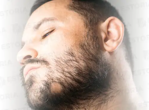 Beard-and-Mustache-Transplantation-2