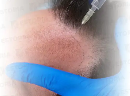DHI-Hair-Transplant-2