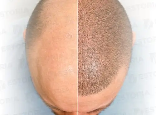 FUE-Hair-Transplant-3