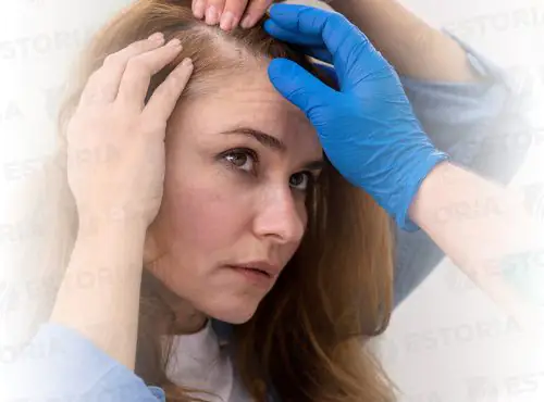 Hair-Transplant-For-Women-1